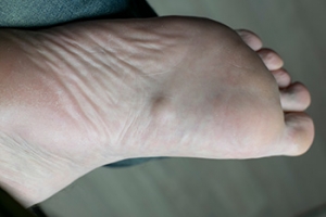 Care Options for Plantar Fibroma
