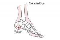 Two Places Where Heel Spurs Can Form