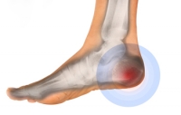 Top Causes of Heel Pain in Seniors