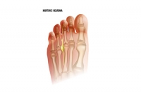 Signs of Morton's Neuroma
