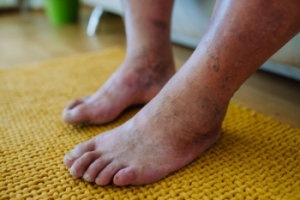 Foot Problems Linked to Diabetes
