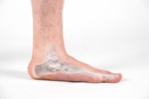 When Low Arches Affect Comfort and Stability