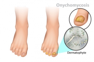 Tracing the Signs of Fungal Toenails